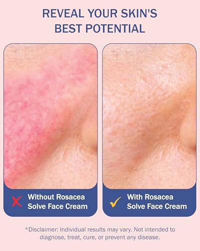 e70 Rosacea Treatment Face Moisturizer Pack of 2 - Redness Reducing Aloe & Hyaluronic Acid - 2.25 fl oz