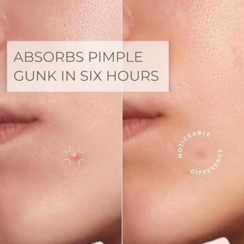 Pimple Patches ? Hydrocolloid Pimple Patches for Face and Skin, Invisible Acne Patches for Pimples, Whiteheads & Blemishes- Ultra-Thin Spot Covers for Day or Overnight Use- 108 Ct.