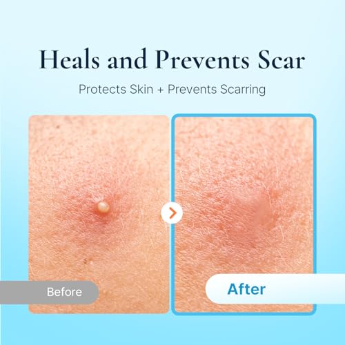 DERMAKR 4-Pack Hydrocolloid Acne Pimple Patches - Invisible Spot Cover & Treatment