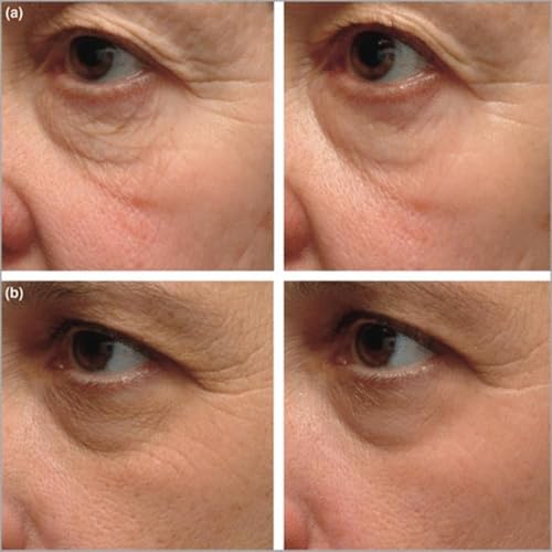 Instant Firming Eye Serum, Anti-Aging Formula for Under Bags and Wrinkles, Under Eye Cream, Wrinkle Filler, Visibly Improves for Bags Dark Circles Treatment for Puffines, 15ml (Scentless)