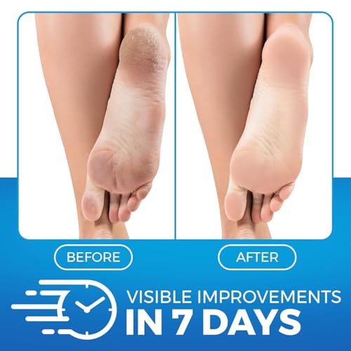 Urea Foot Balm for Cracked Heels & Rough Skin - 5.07oz Moisturizer