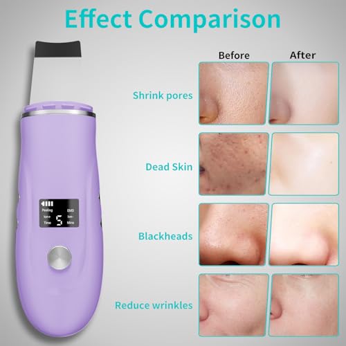 Face Scrubber Skin Spatula Blackhead Remover for Pore Cleansing - Purple