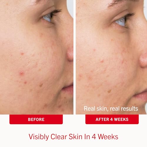 First Aid Beauty Acne Treatment Pads 2% Salicylic Acid - 28 Count