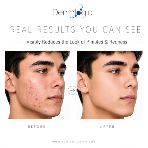 Dermlogic Acne Spot Treatment - Fast-Acting Clear Skin Formula for Face & Body