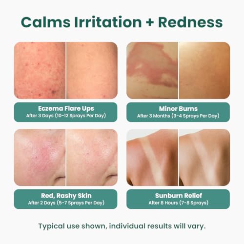 Hypochlorous Acid Face & Skin Spray - Gentle Acne & Skin Care Mist, Travel Size