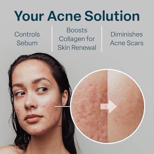 QRxLabs Glycolic/Salicylic Acid 10/2 Acne Control Pads with 10% Ultra Pure Glycolic + 2% Salicylic Acid, Allantoin, Vitamins B5, C & E, Calendula Green Tea - Most Effective Treatment Clear Skin - 2PK