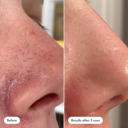 Mighty Patch Nose & Pore Release Duo for Blackhead & Oil Removal