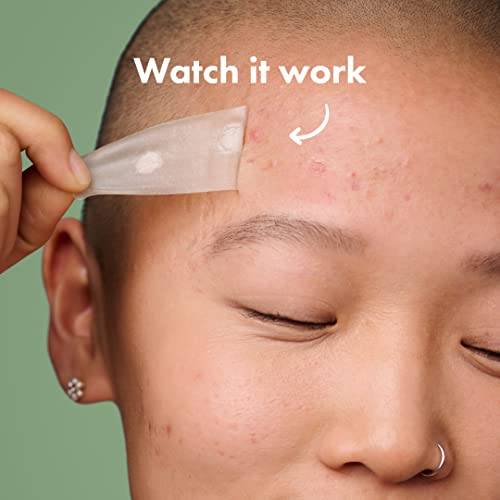 Acne Patches Bundle - Clear Skin Overnight, Large & Small Spots