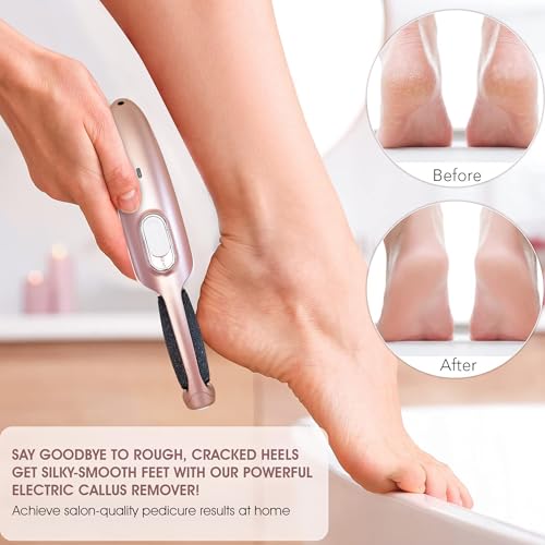 Powerful Electric Callus Remover Wand ? Rechargeable Foot File, Grinder & Scrubber - Removes Dead, Hard Skin & Calluses ? Best Pedicure Tool for Soft, Smooth Feet for Men & Women (Rose Gold)