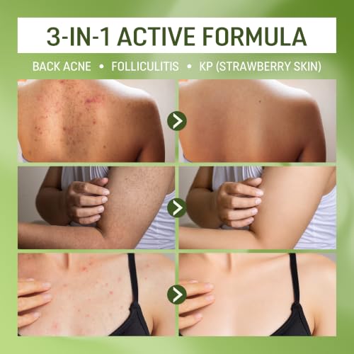 ABERA High-Performance Folliculitis Body Wash with Wild Bitter Melon & BHA - 2 Boxes + BHA Acne Spray Gift