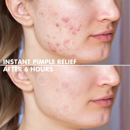 e.l.f. SKIN Blemish Breakthrough Stick It To Zits Pimple Patches, Helps Reduce The Look of Blemishes & Heal, Vegan & Cruelty-free, 36 Patches
