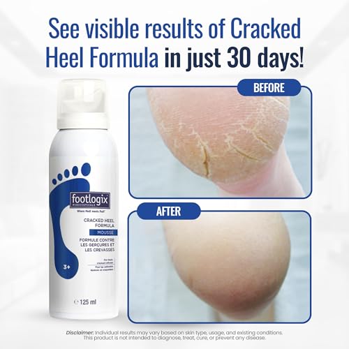 Footlogix Cracked Heel Mousse with Urea & Primrose Oil 4.23oz - Dry, Callused Feet Care