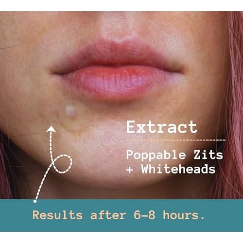 TKTK Pimple Patches Pimple Patches for Face Hydrocolloid Acne Patches Zit Patches for Chin and Nose Skin Care 5 Sizes 136 Count