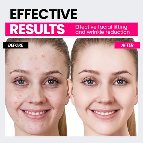 Microcurrent Facial Device,Latest Red Light Technology,Enhances The Ability to Lift The Face and Tighten The Skin,Facial Wrinkle Equipment,Smart Photon Micro-Current Device,Model:EP-300.