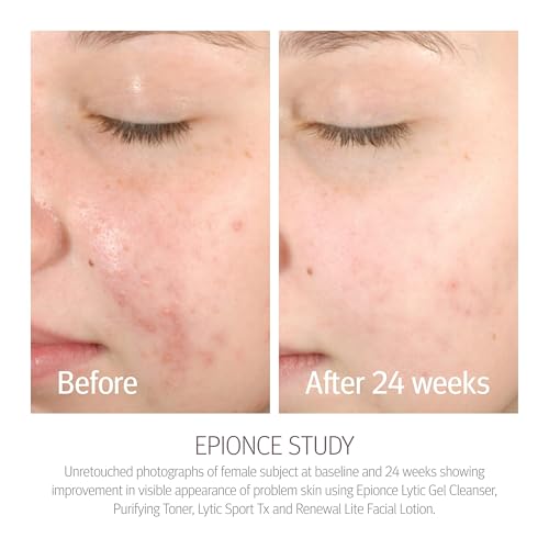 Purifying Toner for Face and Body - Blemish & Blackhead Clarifying Spray