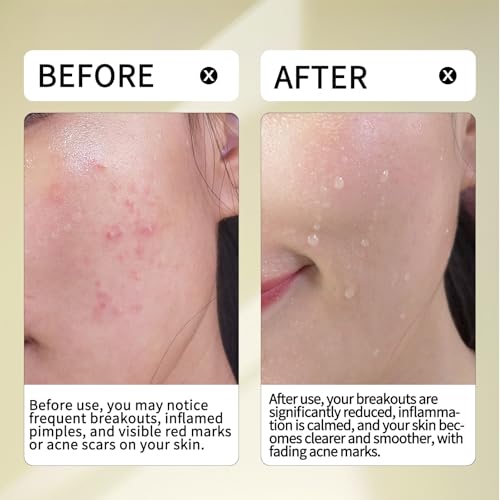 Multi-Acid 20% Serum-10% Azelaic Acid & 3% Tranexamic Acid - 5% Zinc PCA & 2% Salicylic Acid - 20% Active Formula for Blemish Care, Visible Post-Acne Marks & Texture Refining