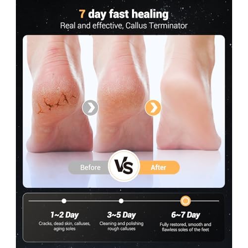 Electric Foot Callus Remover,Rechargeable Electric Callus Remover for Feet¡¼Variable 3-Speed & LED Light¡½¡¼Removes 99.92% of Calluses¡½ Portable Foot File Pedicure Kits with 30 Grit Pads-Silver