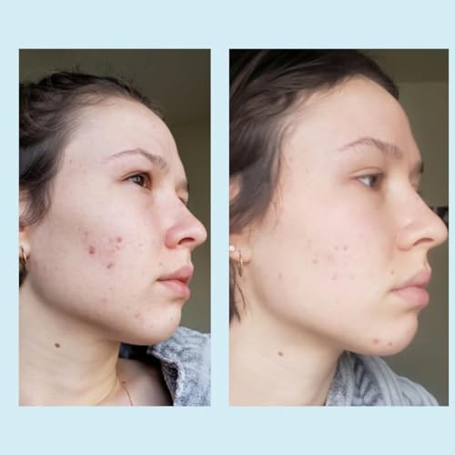Glycolic Acid 50% Gel Peel with Retinol & Green Tea Extract - Professional Skin Exfoliant, 1 oz (50% Strength)