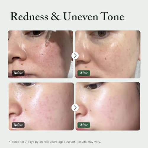 Azelaic Acid 10% Serum for Uneven Skin Tone & Blemish Marks - 1 fl oz