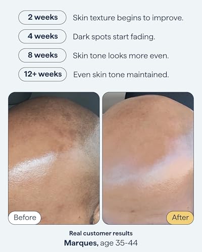 Dark Spot Correcting Serum with Retinol & Brightening Ingredients - Vegan & Cruelty-Free