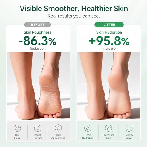 Urea Cream 40% for Feet with Salicylic Acid, Callus & Cracked Heel Care - 6 OZ Pack of 3