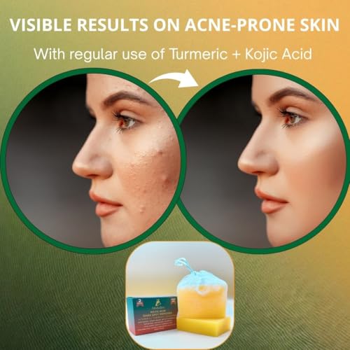 Altobello's Turmeric Kojic Acid Soap - Dark Spots Remover for Face & Body, Brightening Skin Lightening Bar with Vitamin C, Collagen, Hyaluronic Acid - 2 Bars + Exfoliating Net.