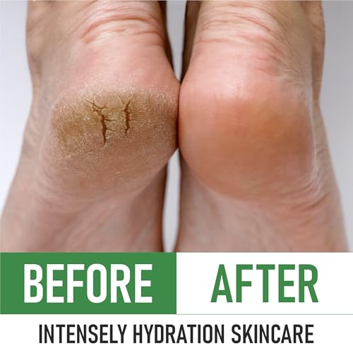 Urea 40% Foot Cream - Made in USA - Corn, Callus and Dead Skin Remover - Moisturizer & Rehydrater - For Thick, Cracked, Rough, Dead & Dry Skin - For Feet, Elbows and Hands - Pack of 2