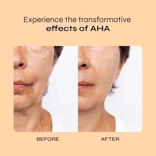 A-Cute Derm Ultra 10 AHA Anti-Aging Lotion 4 oz – Exfoliating Face & Body