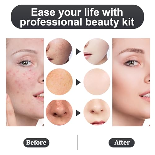 Silver Blackhead Remover Kit 11Pcs with Magnifying Glass & Alcohol Pads - Acne Extraction Tools
