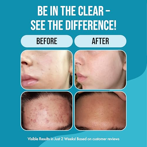 Teenology Sulfate Paraben-Free Face Wash for Acne-Prone Skin - Gentle & Hydrating