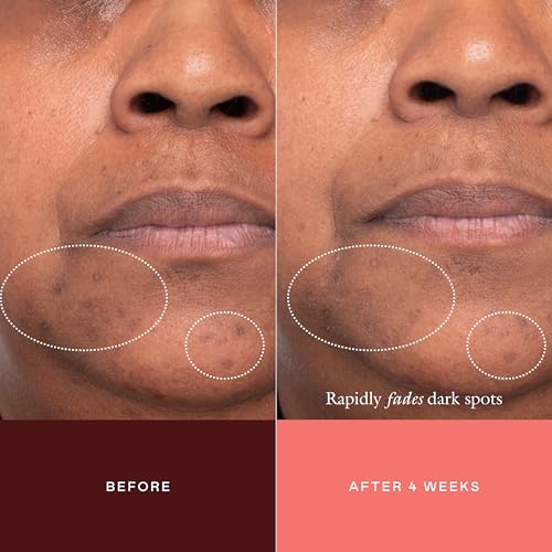 Dark Spot Serum with Tranexamic Acid - Targeted Face Concentrate for Hyperpigmentation
