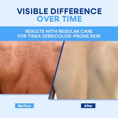 Hermon Tinea Versicolor Soap 8oz Pack of 2 – Antifungal Cleansing Bars for Skin Health