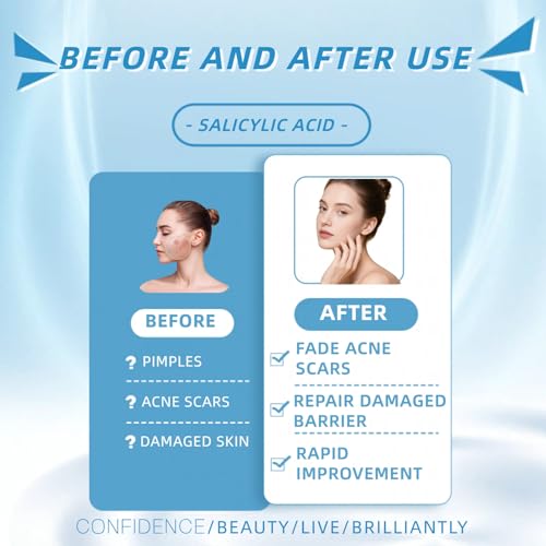 Salicylic Acid Drying Lotion ? Improve Skin Condition, Oil Control, Gentle Skincare for Sensitive Skin 10ml/0.35fl.Oz (2pc)