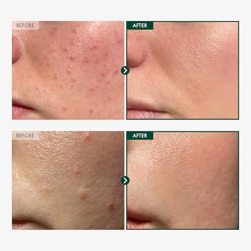 Centella Asiatica Ampoule for Sensitive Skin - Soothing & Calming, 86% Centella