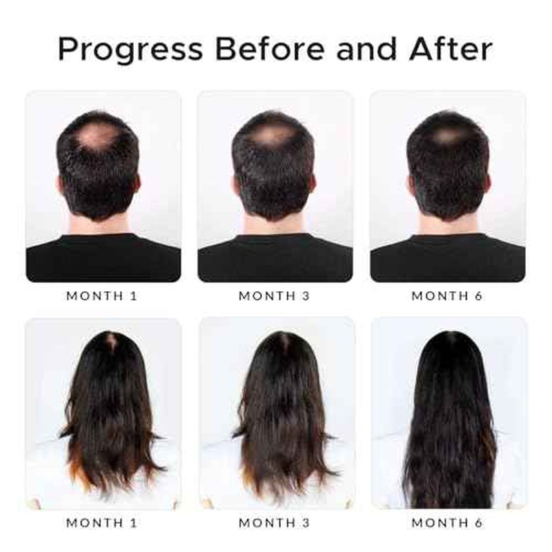 Minoxidil & Biotin Shampoo for Hair Growth - Enriched with Caffeine, Castor Oil & Onion - DHT Blocker for Thicker, Healthier Hair - Strengthening Formula for Men & Women