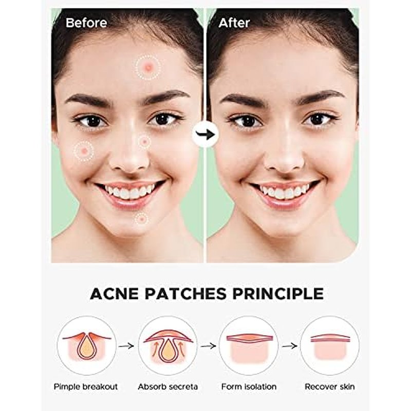 Acne Pimple Patch (180 Counts 4 Sizes), FSA Eligible Invisible Hydrocolloid Acne Patch with Tea Tree Oil & Calendula Oil, Acne Spot Patch Zit Patches for Face