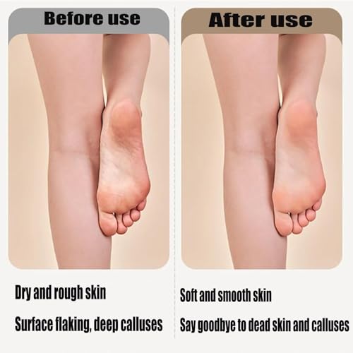 Dermawe Electric Foot Callus Remover, Dermave Foot Sander, with 60pcs Sanding Disc, Electric Foot File Adjustable Speed Callus Remover Tool, Foot Grinder Callus Remover Heavy Duty (Gold)