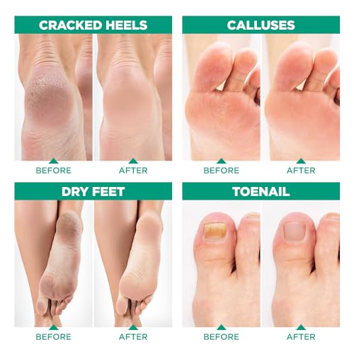 Foot Peel Mask and Tea Tree Foot Soak Kit for Cracked Heels & Odor Relief