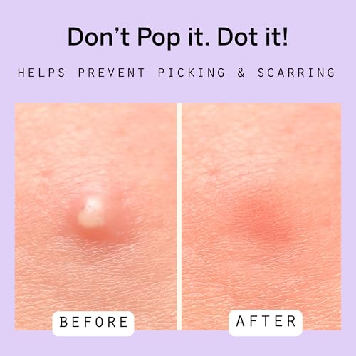 Pixie Cup Dot Hydrocolloid Blemish Patches for Face ? Invisible Skin-Covering Stickers with Tea Tree Oil & Vitamin C ? Ultra-Thin Cosmetic Patches for Visible Blemishes (10 mm, 120 ct)