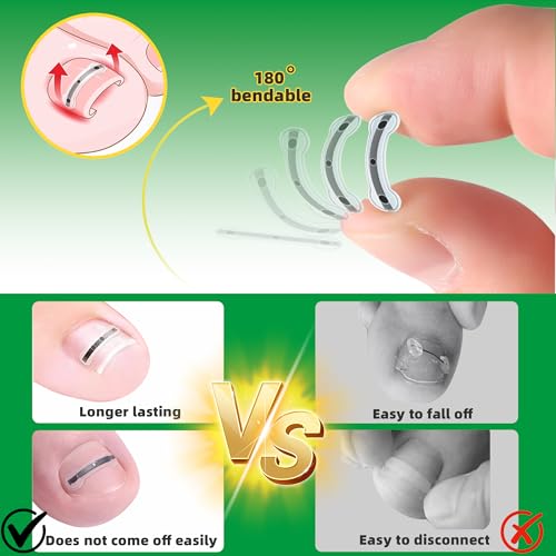 Ingrown Toenail Treatment Kit, Titanium Alloy Ingrown Toenail Removal Kit, Nails Corrector Tool & Remover Strips - Ingrown Toe Nail Quick Relief