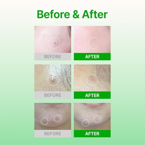 Acropass Microcone Acne Patches - Spot & Blemish Treatment, 18 Count