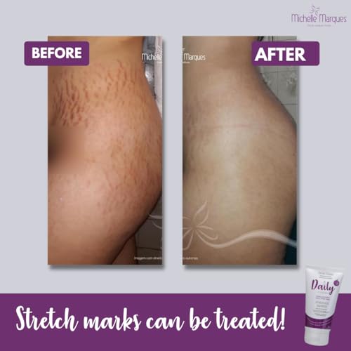 Stretch Mark Cream, Soften and Reduce the Appearance, Provides Hydration, and Improves Skin Elasticity and Texture, 5.29oz