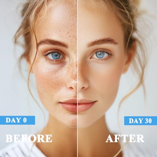 Dark Spot Remover for Face and Body, Dark Spot Corrector, Sun Spot Freckles Hyperpigmentation Treatment, Advanced Dark Spot Remover Cream with Niacinamide for Women and Men (1.7 Fl Oz)