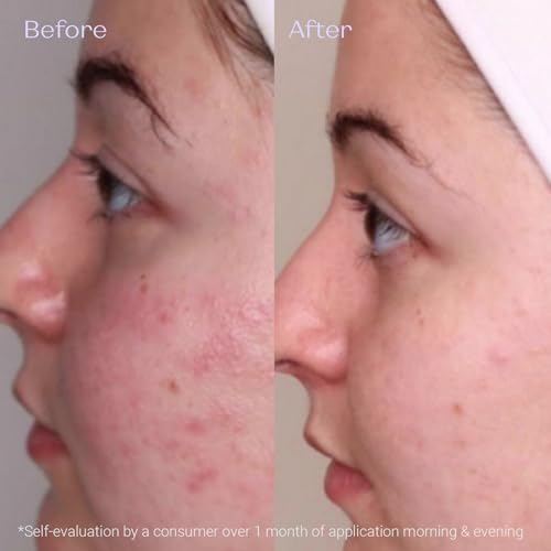 Purifying Mattifying Cream for Oily Skin - Balances & Tightens Pores