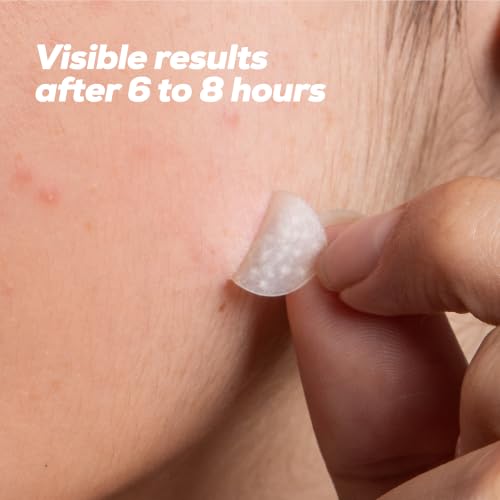 Hydrocolloid Acne Patches Set - 288 Count, Clear Surface Blemish Cover