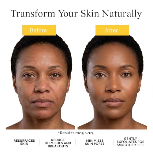 Gentle Enzyme Face Peel for Sensitive Skin - Chemical Exfoliant & Dead Skin Remover