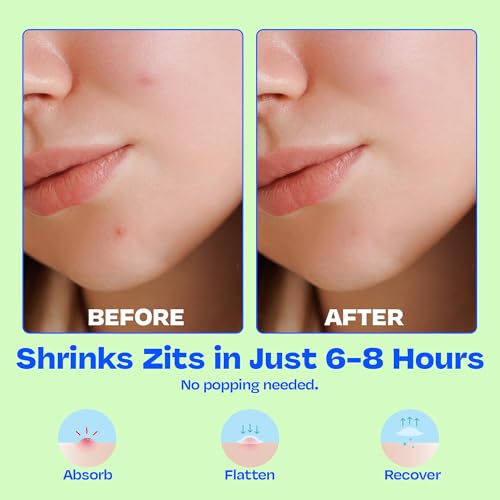 Salicylic Acid Pimple Patches 75ct Pack of 3 - Hydrocolloid Acne Dots for Face