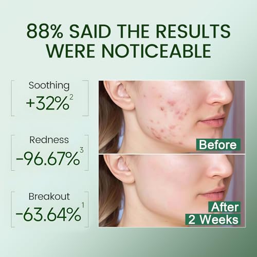 Olive Therapy Face Serum - Acne & Oil Control with 22% Olive Extracts – 0.5 Fl Oz