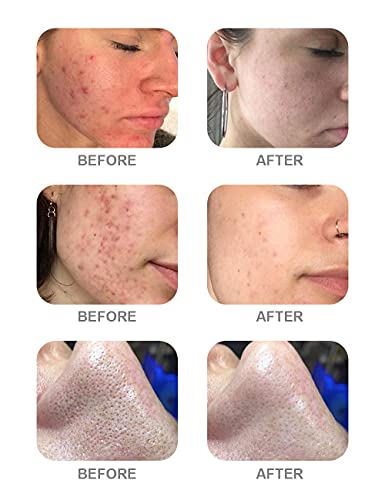 Aqua Peeling Solution Set 13.5 Fl Oz Pack of 3 - Skin Exfoliating Serum for Salon Use