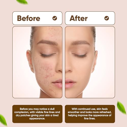 Bio Drying Lotion for Acne & Blemishes - Targeted Spot Treatment, 0.68 fl oz
